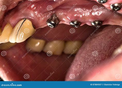 Dental Implants Placement in Real Pacient Stock Image - Image of cuff, implant: 87884507