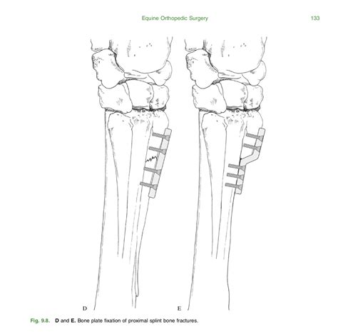 Splint Removal 的图像结果