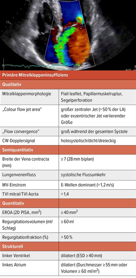 Quantifizierung & interventionelle Therapie der Mitralklappeninsuffizi ...