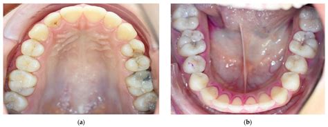 Introducing an Innovative Approach for Managing Proximal Non-Cavitated ...