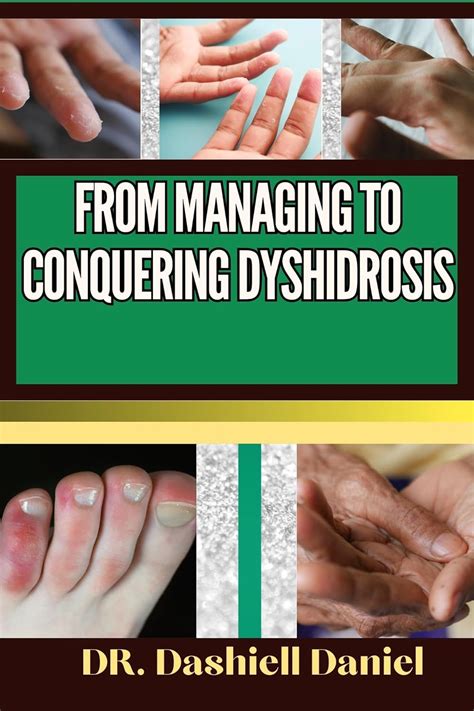 FROM MANAGING TO CONQUERING DYSHIDROSIS : Expert Guide To Understanding ...