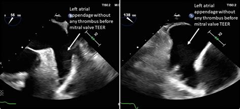 Acute Left Atrial Appendage Thrombus Formation During Transcatheter Mitral Valve Edge-to-Edge ...
