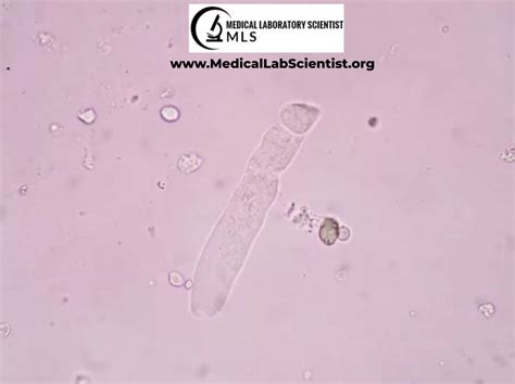 URINARY CASTS: Types, Composition, Significance, Causes, Diagnosis ...