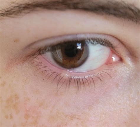 Basal Cell Carcinoma Eyelid Malignant Eyelid Tumours The ELZA