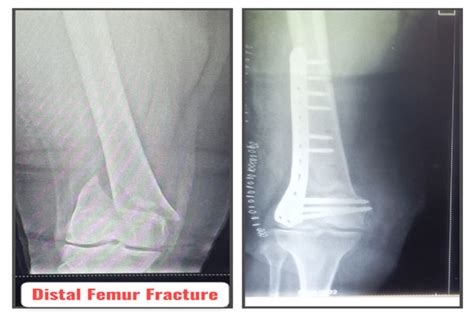 Dr. Sumit Mahajan, Gandhi Nagar, Jammu, Joint Replacement, Knee ...