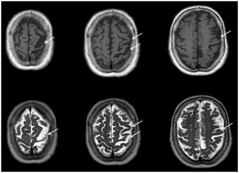 Image result for Alien Arm Syndrome