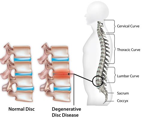 Stages Of Degenerative Disc Disease Neck