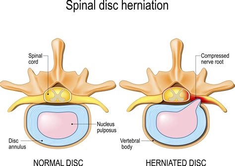 Herniated Disc In Neck Surgery - Bulging Disc vs. Herniated Disc | Orthopedic Associates of West ...