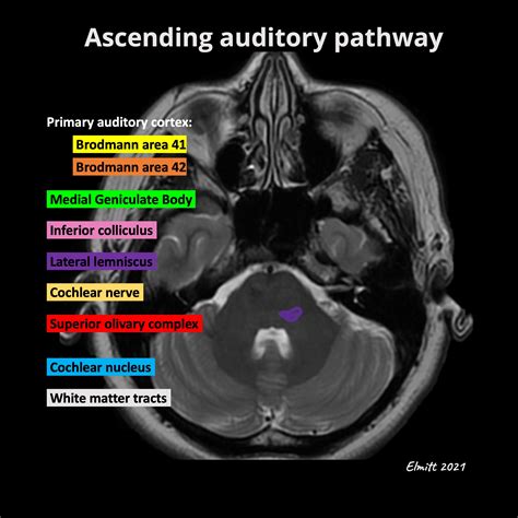 Internal Auditory Meatus Wikipedia Tympanic cavity - Wikipedia
