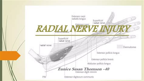 Radial nerve injury | PPTX
