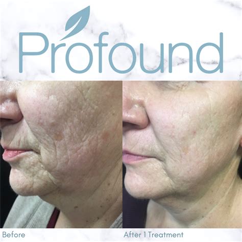 Image result for Profound Face Procedure