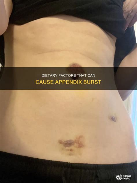 Dietary Factors That Can Cause Appendix Burst | ShunKeto