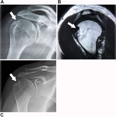 Mimickers of Hill-Sachs Lesions - PMC