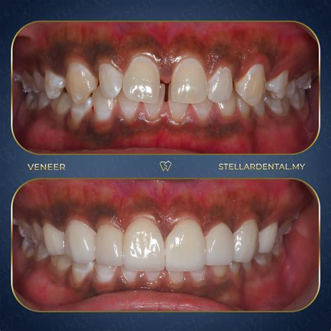 Everything You Need to Know About Teeth Veneers - Stellar Dental