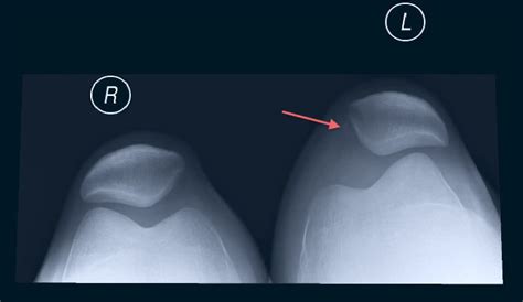 Patella Dislocation - Dr Bradley Seeto