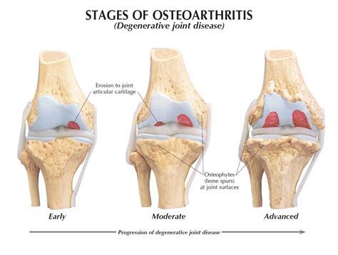 4-Stage Osteoarthritis Knee Model GPI 1100
