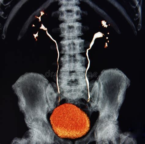 Image result for Urogram CT Scan