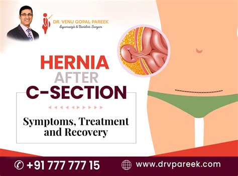 Hernia after C-section: Symptoms, treatment, and recovery - Bariatric ...