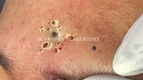 Image result for Exploding Zit Videos 2013