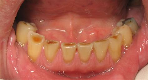 Image result for teeth grinding