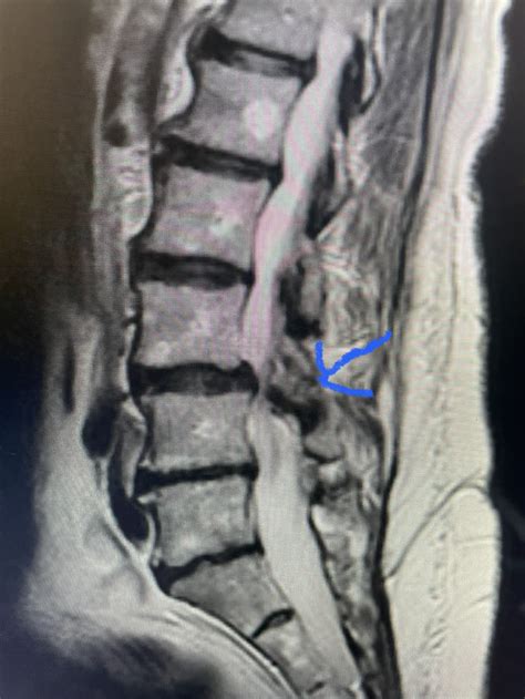 Ligamentum Flavum And Facet Hypertrophy Oxidative Stress Mediates