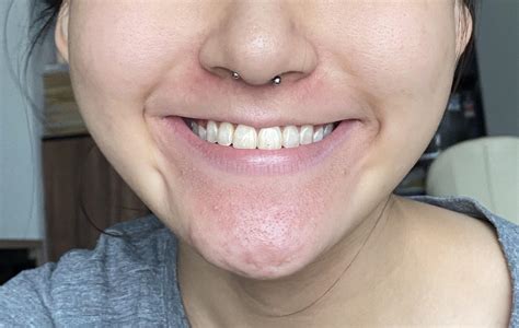 Itchy Rash Under Chin at Jennifer Felder blog