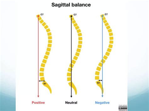 Image result for Spinal Alignment