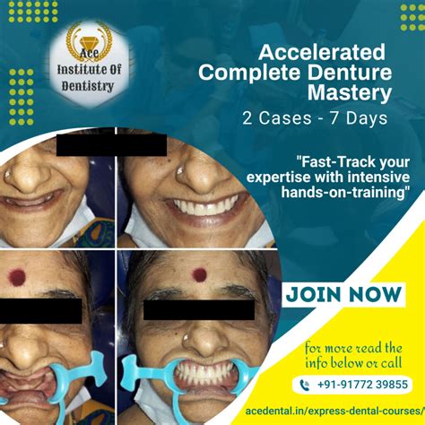 Complete Denture – 2 Cases – 1 Week – Ace Dental
