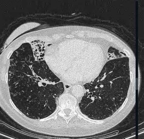 Lady Windermere Syndrome - MEDizzy