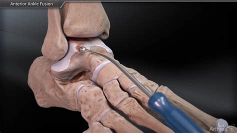 Ankle Fusion Surgery