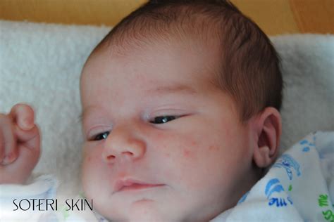 Baby Acne Treatment: Safe & Effective Tips - Soteri Skin