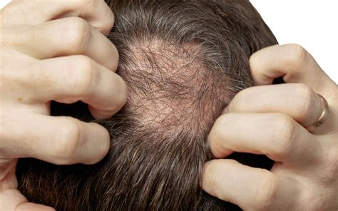 Image result for Diffuse Alopecia