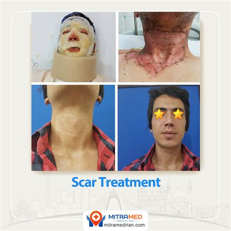 Scar Revision Procedure 的图像结果