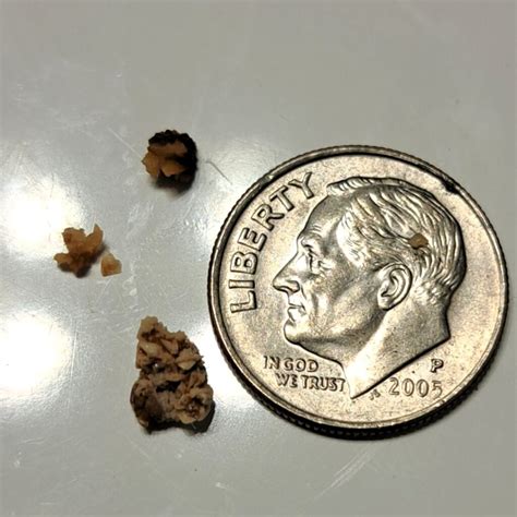 Does soda drinking cause kidney stones?