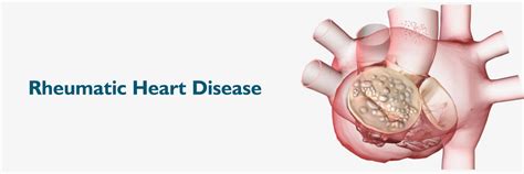 Rheumatic Heart Disease: Causes, Symptoms and Treatment