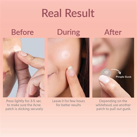 Spot Clearing Acne Pimple patches (114 Patches) – Privedashop