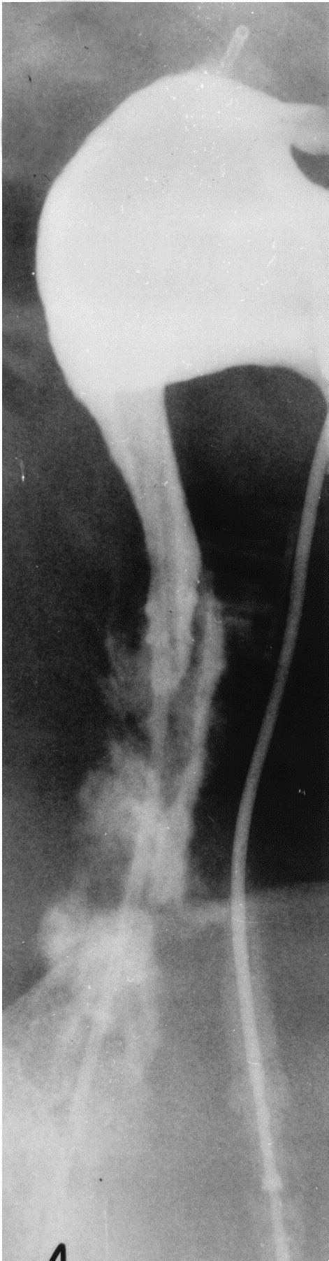 Image result for Hal Nephrectomy