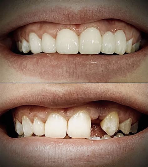 Image result for Broken Tooth