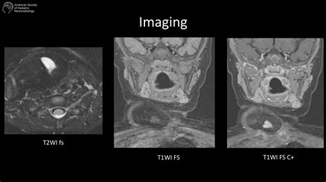17-month-old female with palpable neck mass | American Society of ...