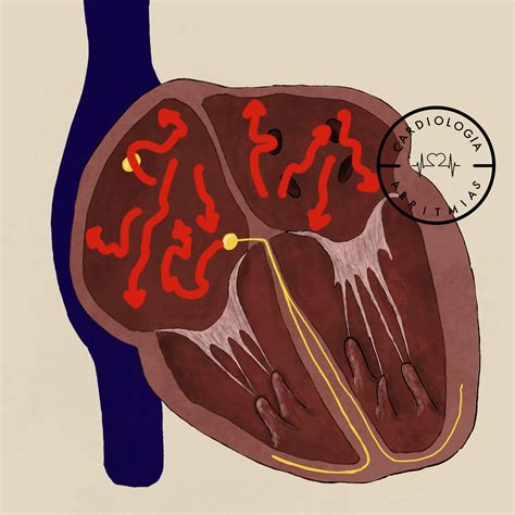 Seleccionar ACOD. Anticoagulante Acción Directa 2026
