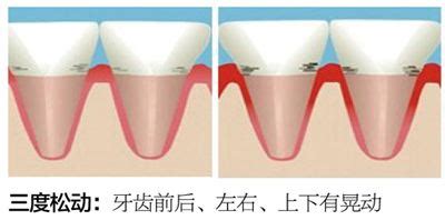 重度牙周治疗后，松动牙牙周夹板固定-浙江牙医刘某某的博客-KQ88口腔博客
