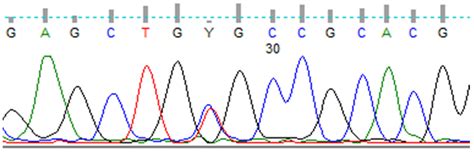Late-Onset Medullary Thyroid Cancer in a Patient with a Germline RET ...