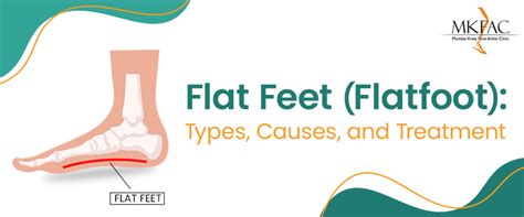 Flat Feet Treatment in Mumbai | Dr. Pradeep Moonot | MKFAC