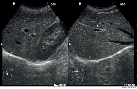 Anatomía ecográfica abdominal normal. Sistemática de exploración ...