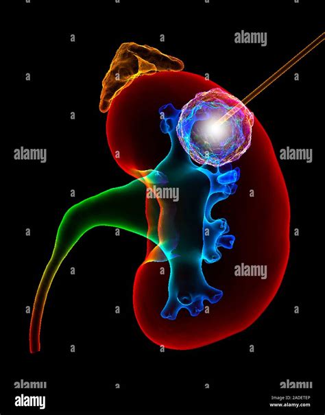 Kidney cancer thermal ablation. Illustration of radiofrequency or microwave ablation for ...