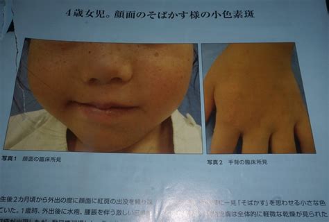 紫外線に弱い先天性疾患 - 伊藤内科医院