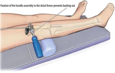 Intramedullary Nail Tibia 的图像结果