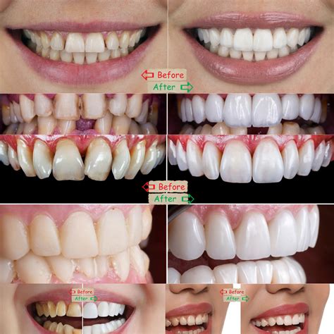 Porcelain Veneers Cost Sydney | Pricing, Benefits, & What To Expect