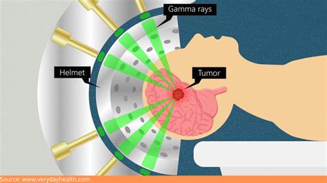 Dr Rao - Dr Mohana Rao Patibandla - Minimally Invasive Neurosurgeon and ...