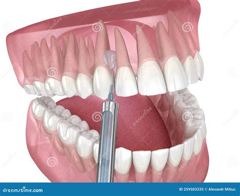 Local Anesthesia Examples 的图像结果
